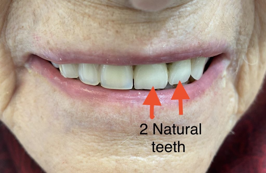 natural teeth